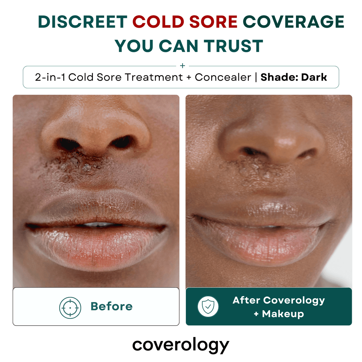 Cold Sore Treatment & Concealer