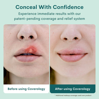 Cold Sore Treatment & Concealer