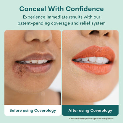 Cold Sore Treatment & Concealer