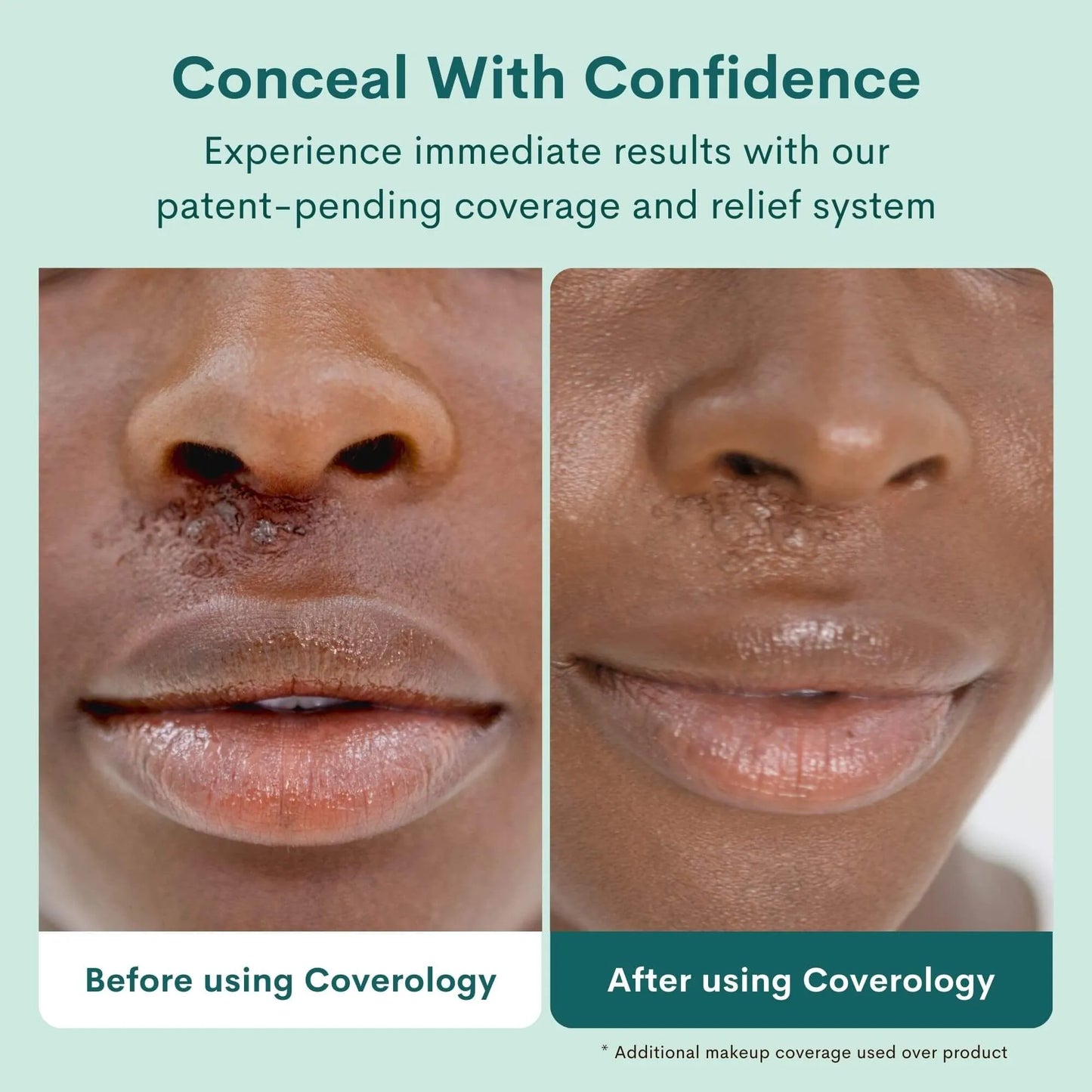 Cold Sore Treatment & Concealer