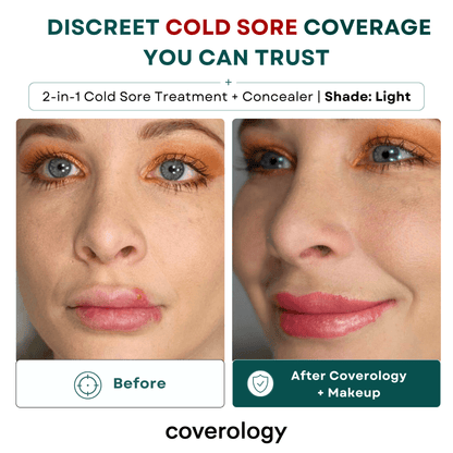 Cold Sore Treatment & Concealer