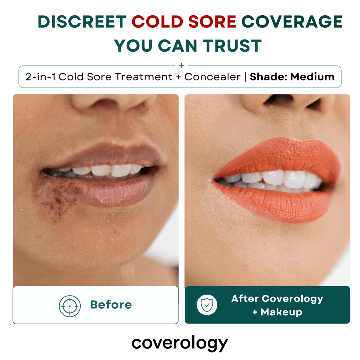 Cold Sore Treatment & Concealer