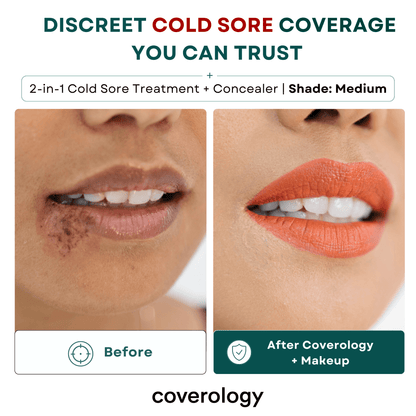 Cold Sore Treatment & Concealer